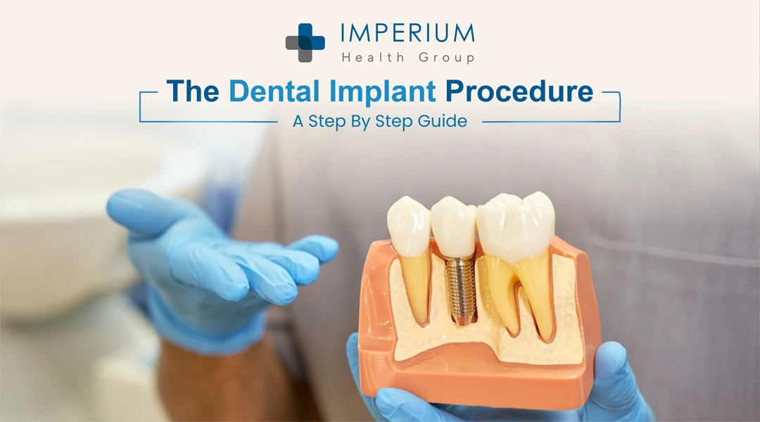 Dental Implant Procedure: Step‑by‑Step Guide