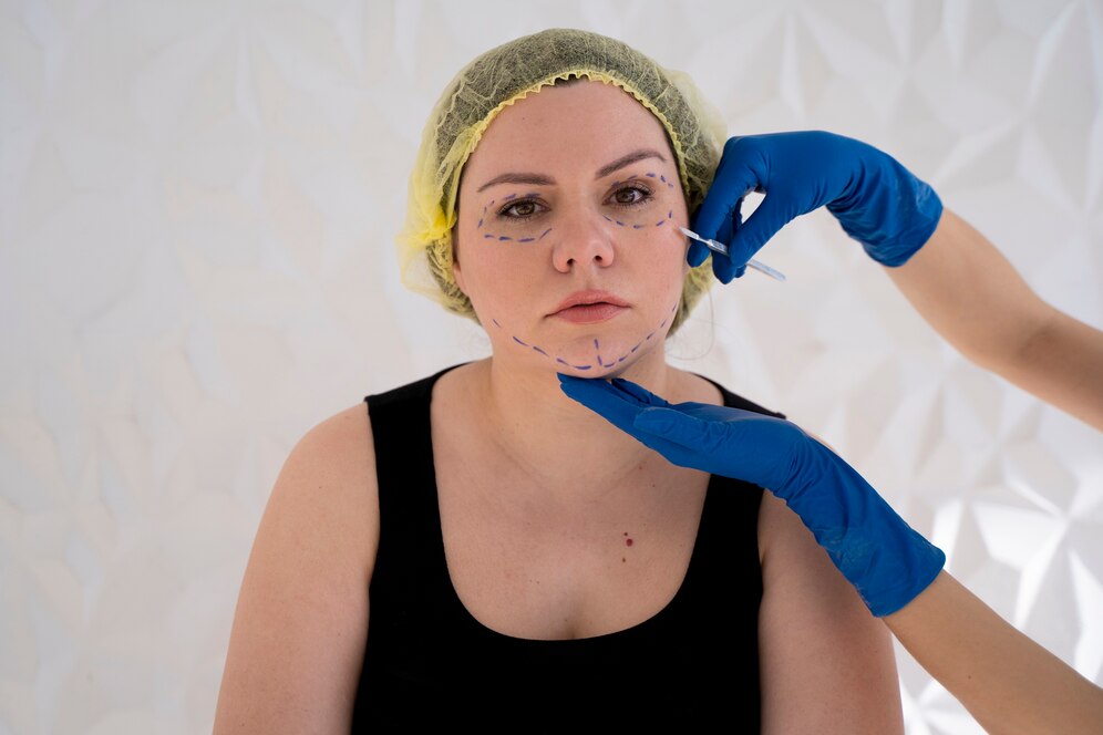 Facelift (Rhytidectomy)