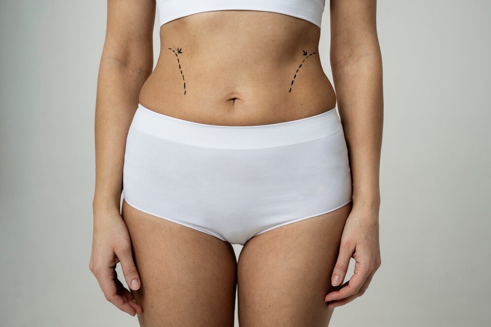 Liposuction
